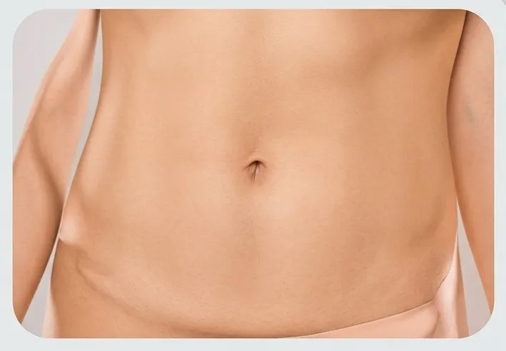 Tumescent Liposuction