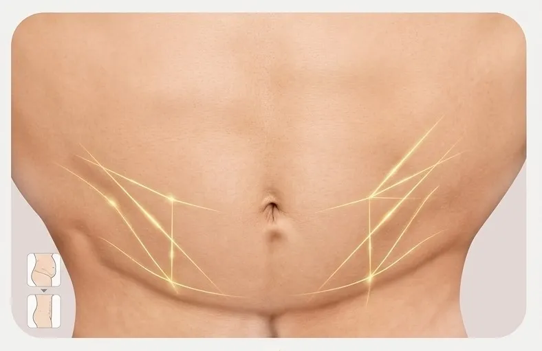 Power-assisted Liposuction