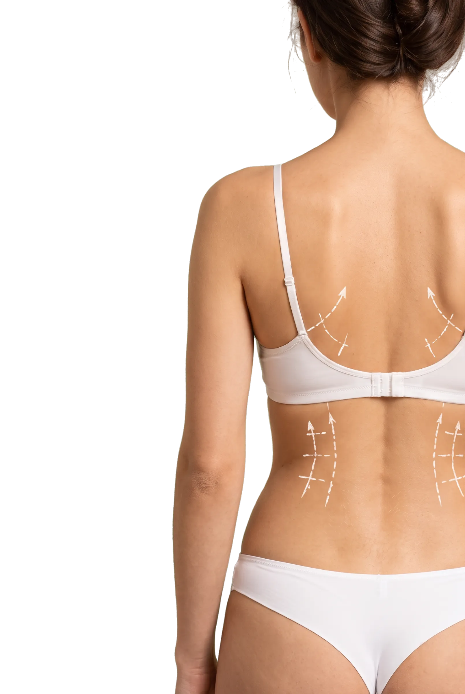 Back Liposuction in Bangalore