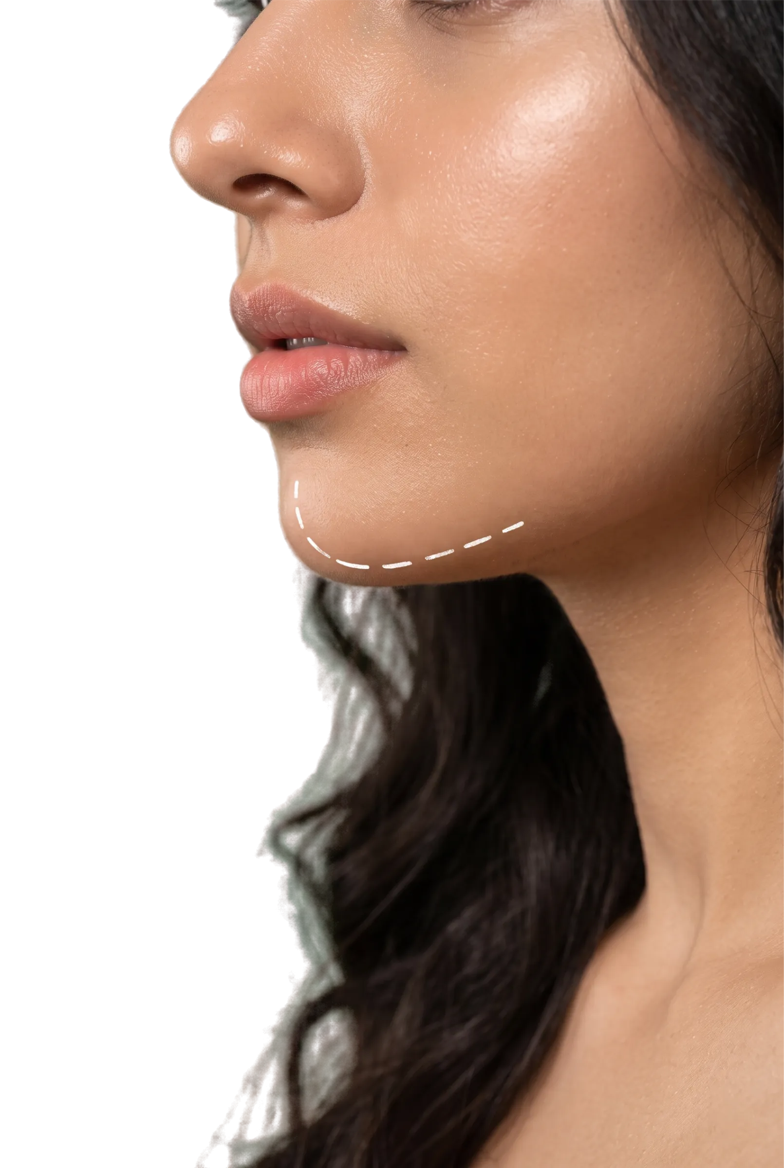 Chin Implant Surgery in Bangalore