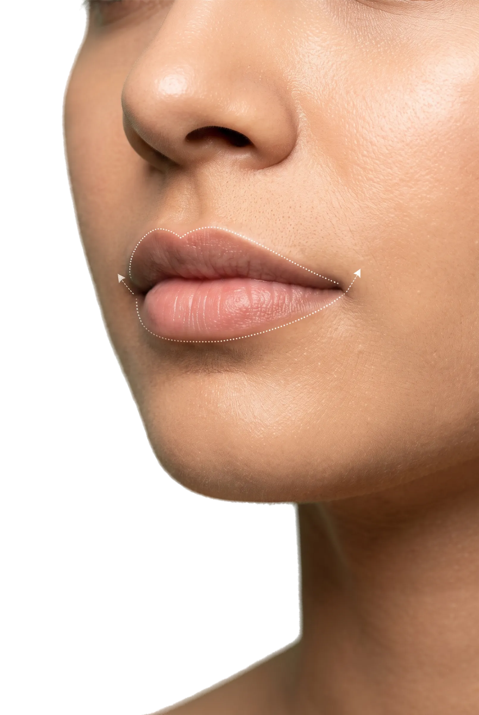 Corner Lip Lift in Bangalore