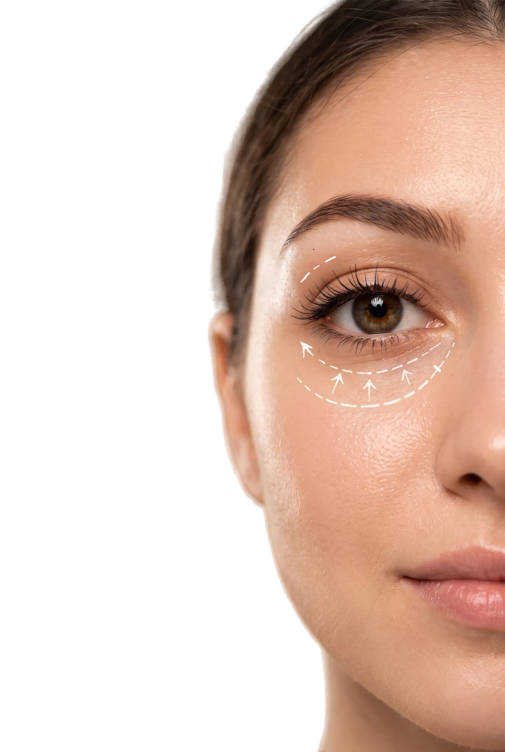 Lower Blepharoplasty in Bangalore