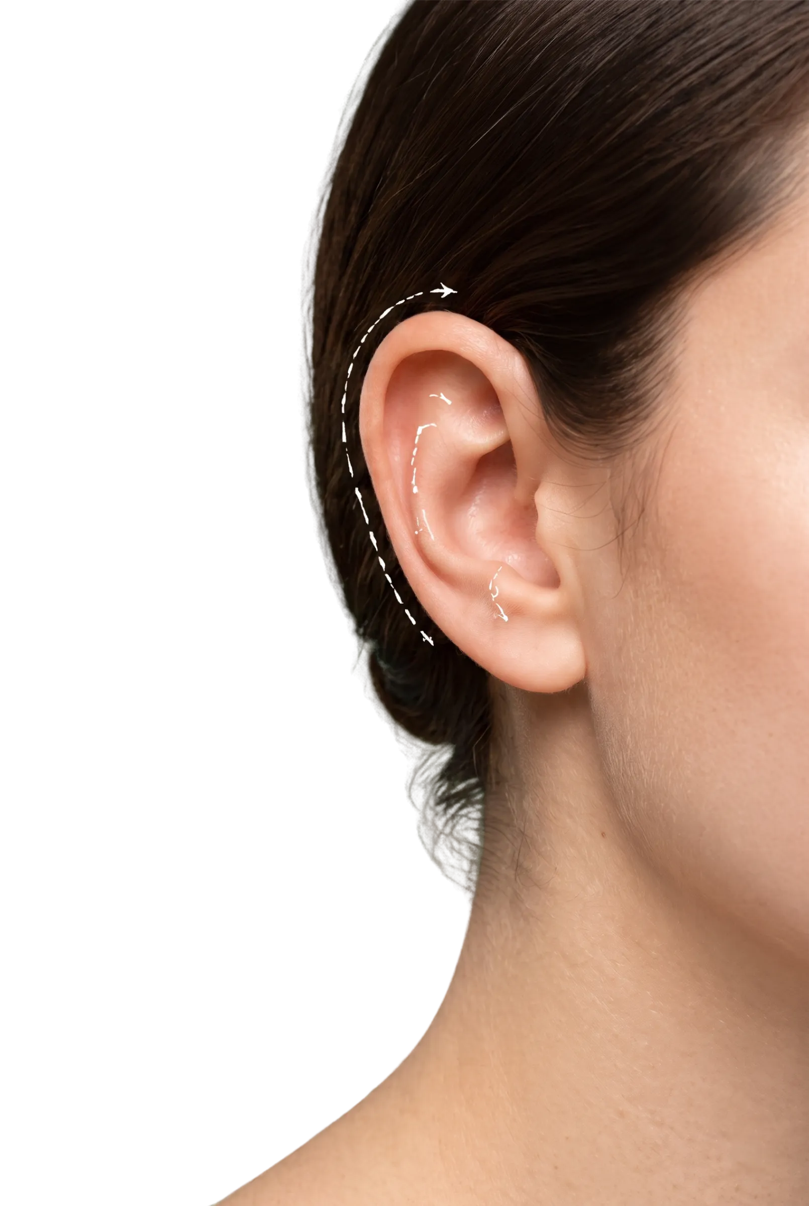 Otoplasty in Bangalore