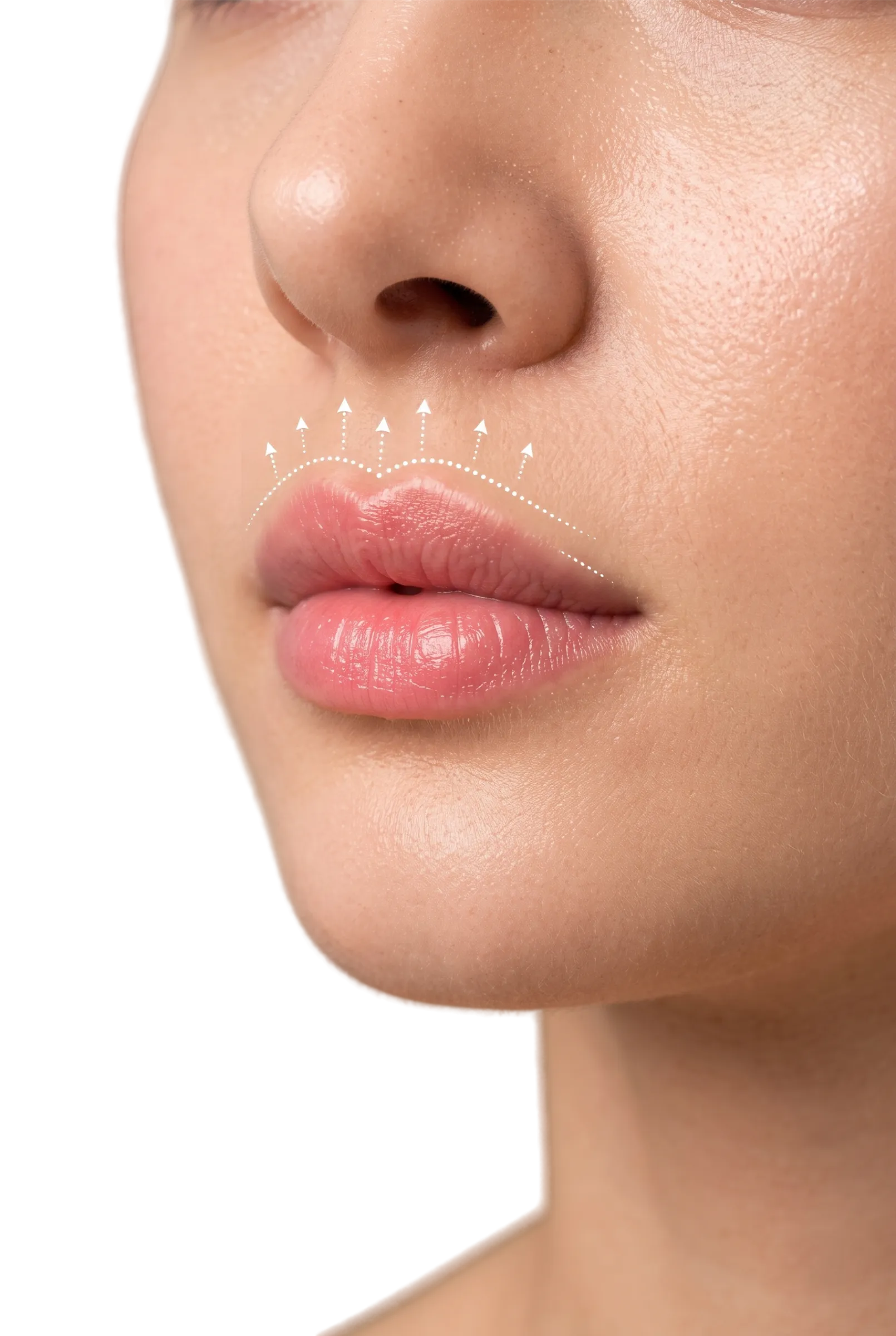 Upper Lip Lift in Bangalore