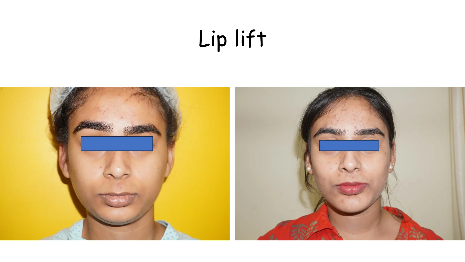 Lip Lift Transformation 1