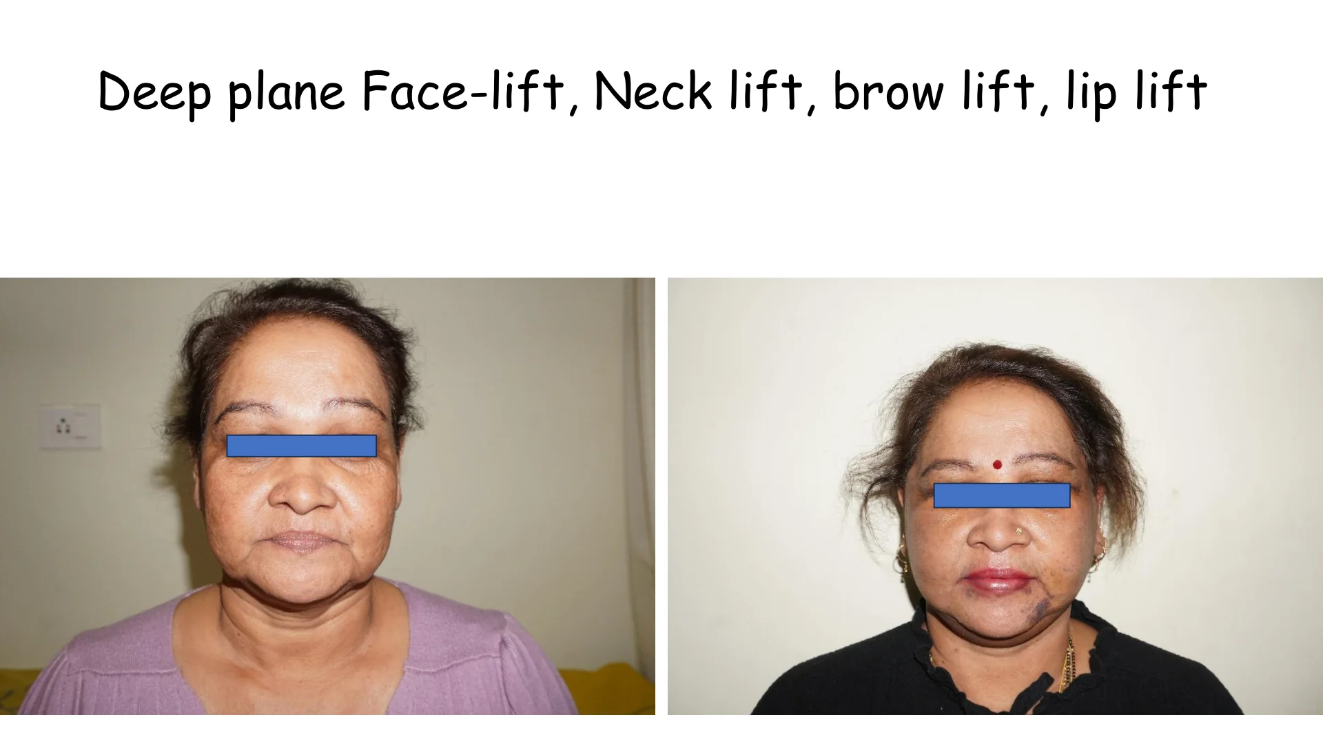 Lip Lift Transformation 10