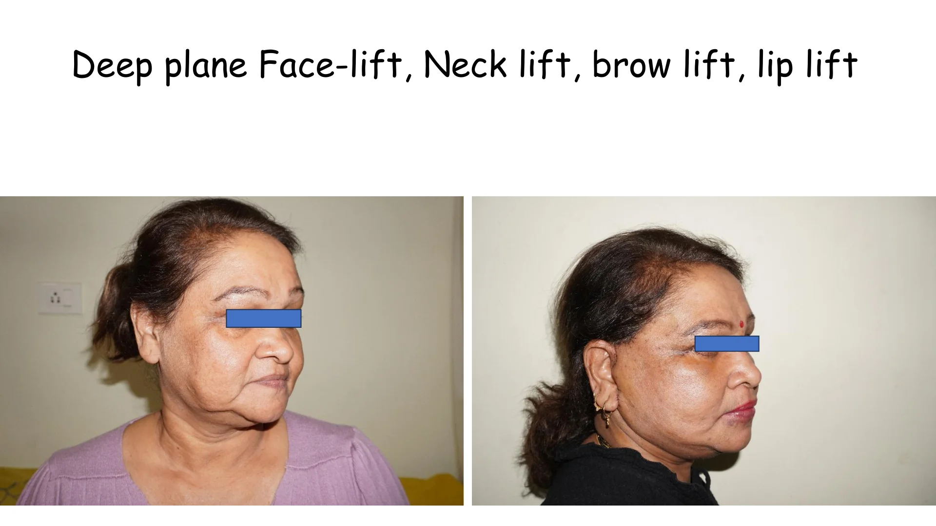 Lip Lift Transformation 11