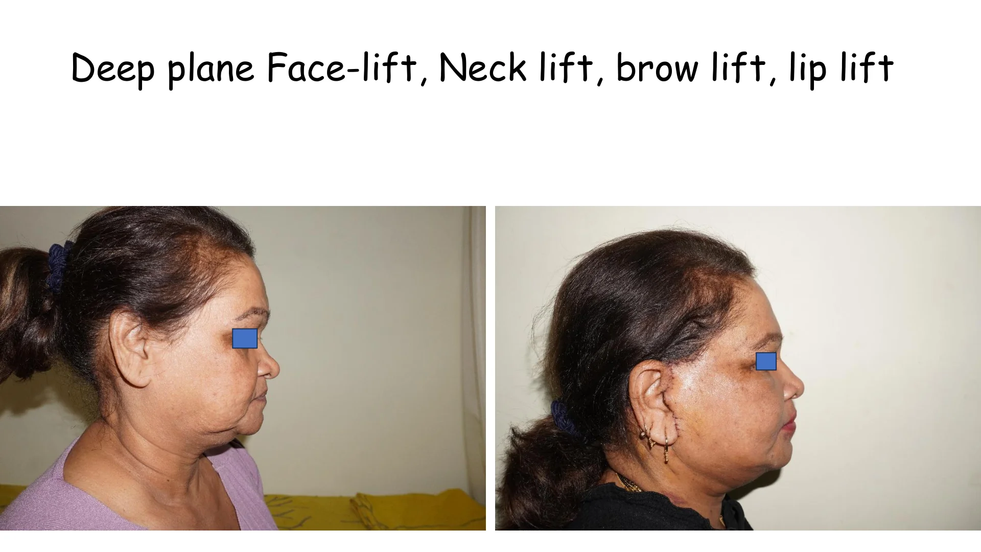 Lip Lift Transformation 12