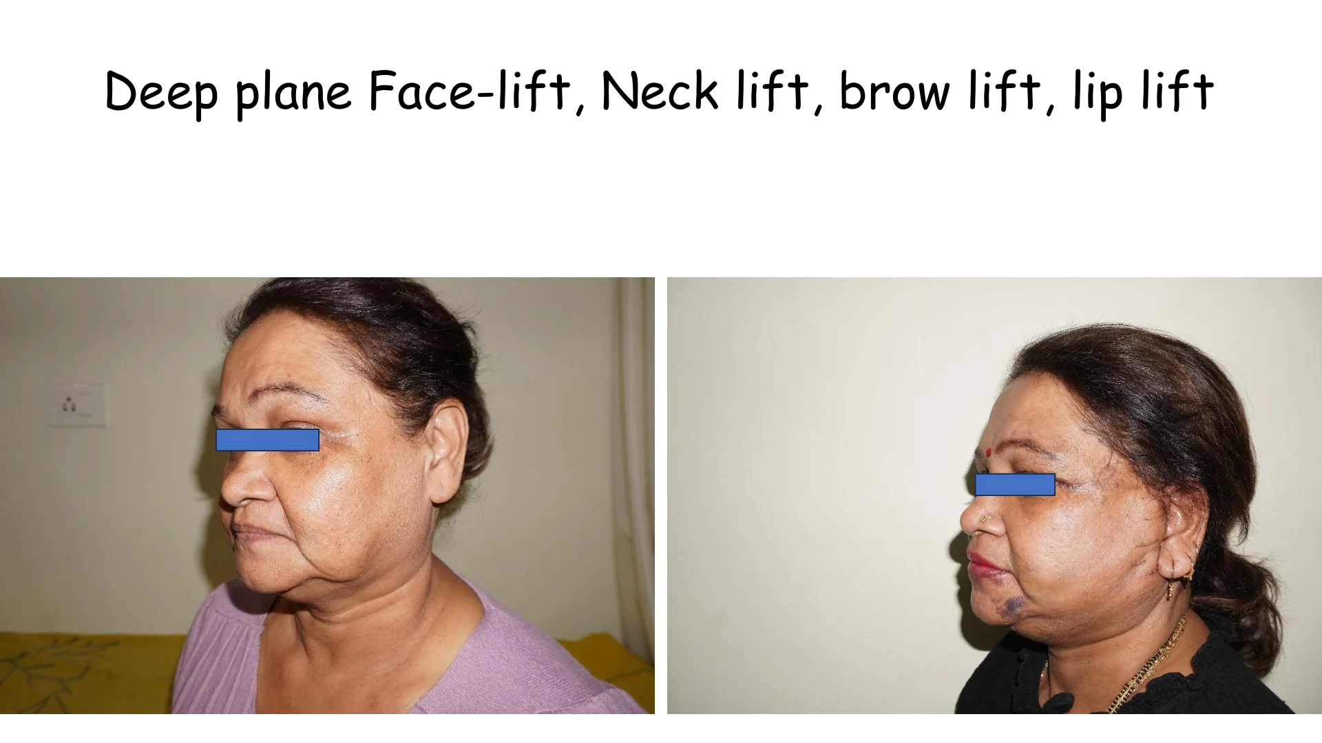 Lip Lift Transformation 13