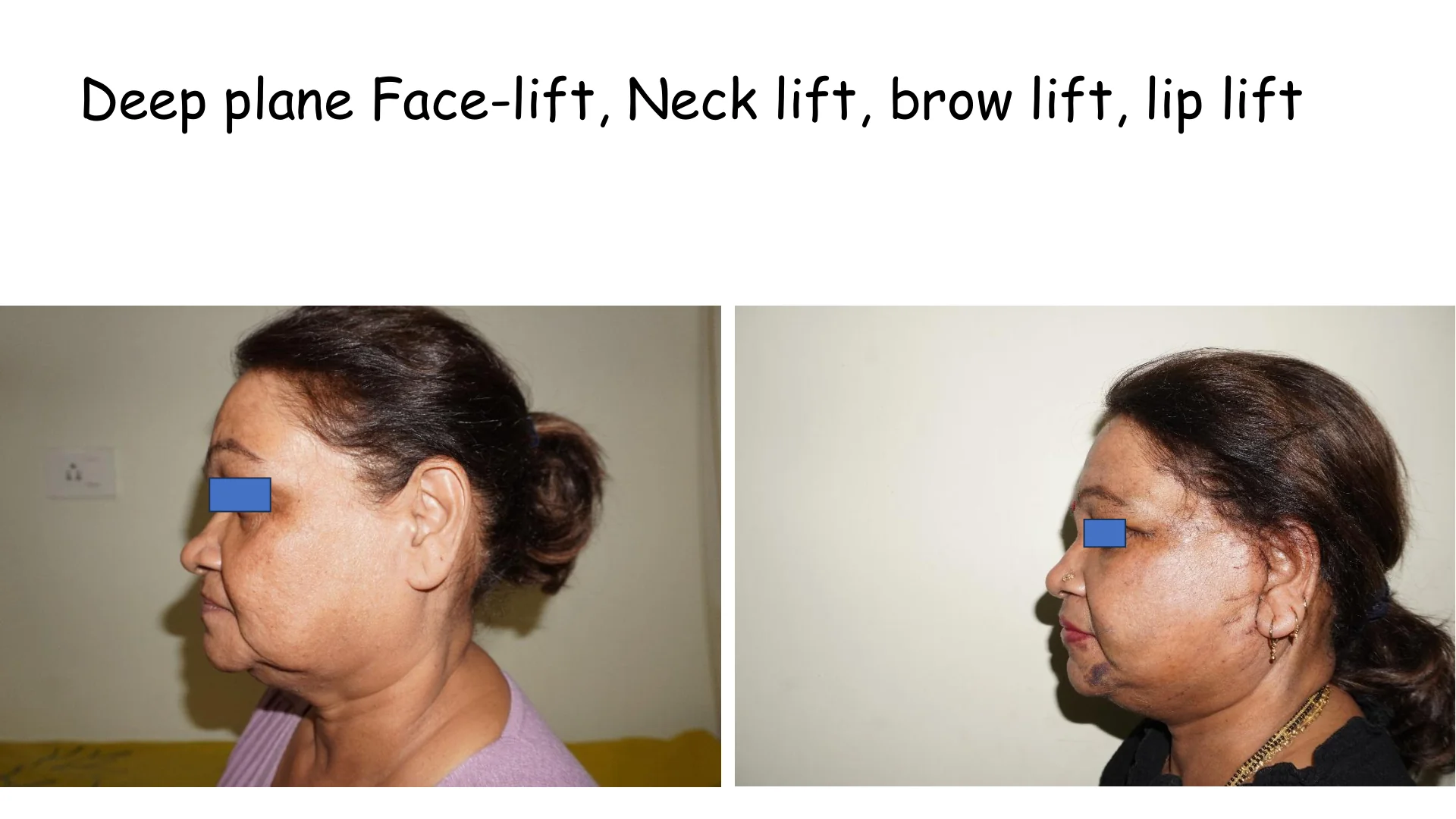 Lip Lift Transformation 14