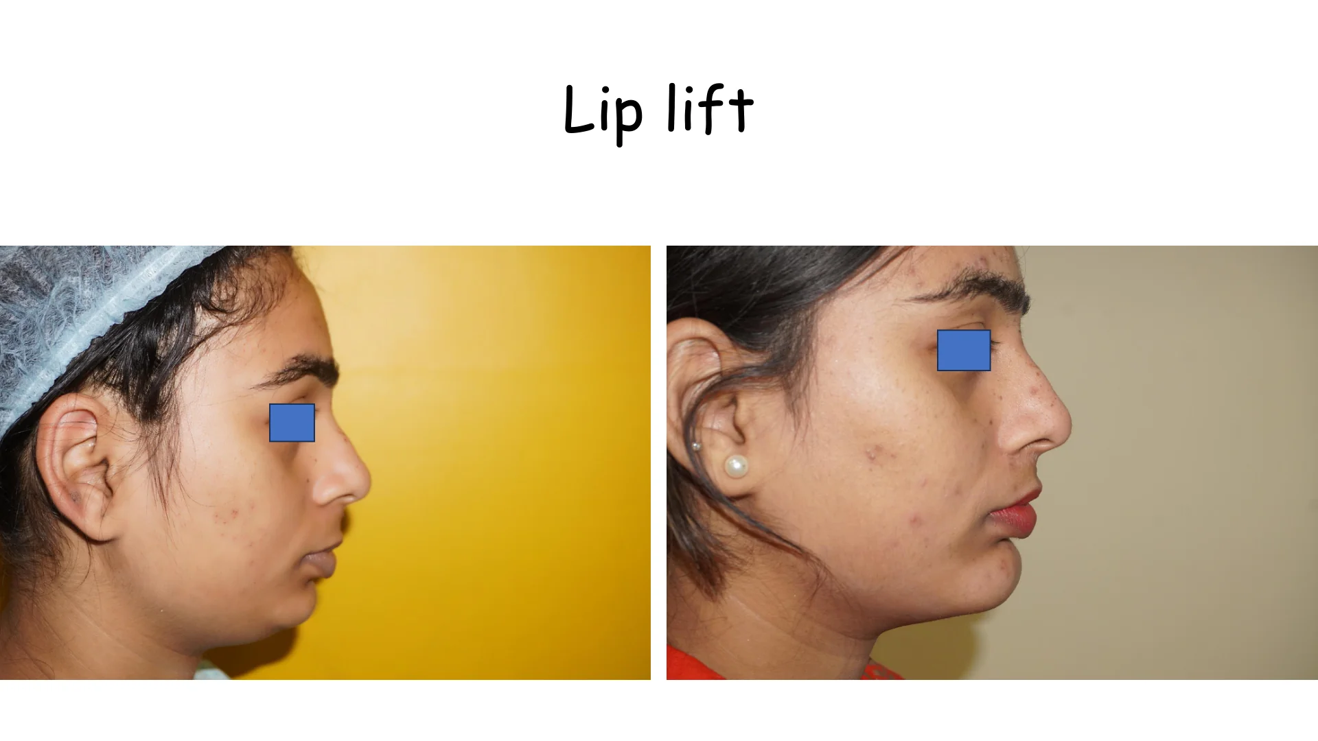Lip Lift Transformation 2