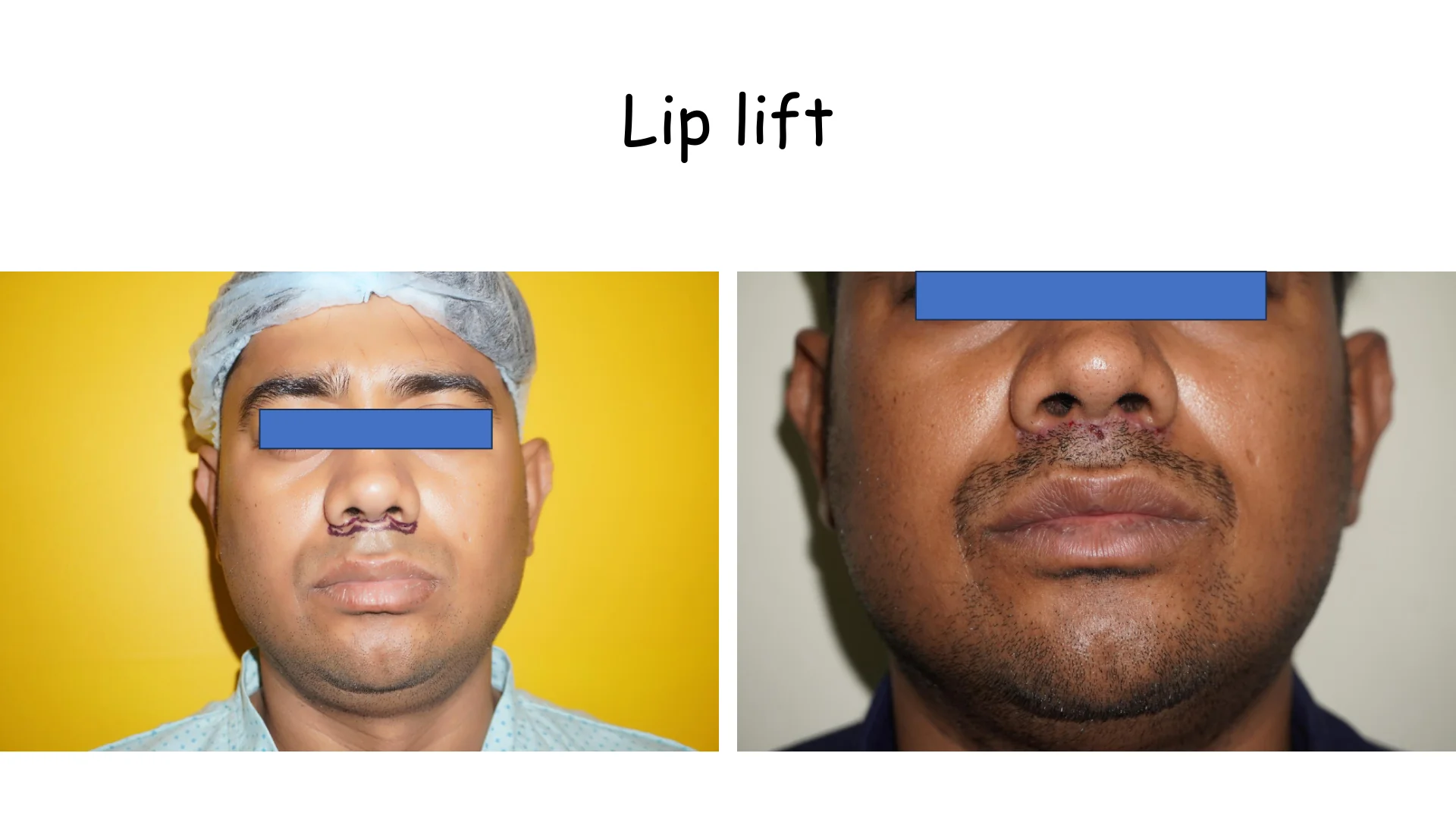 Lip Lift Transformation 3