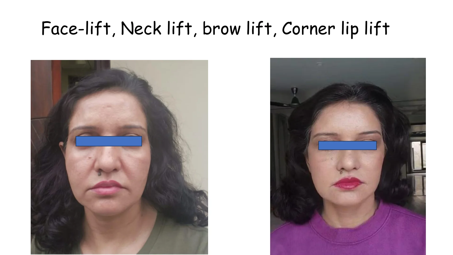 Lip Lift Transformation 4