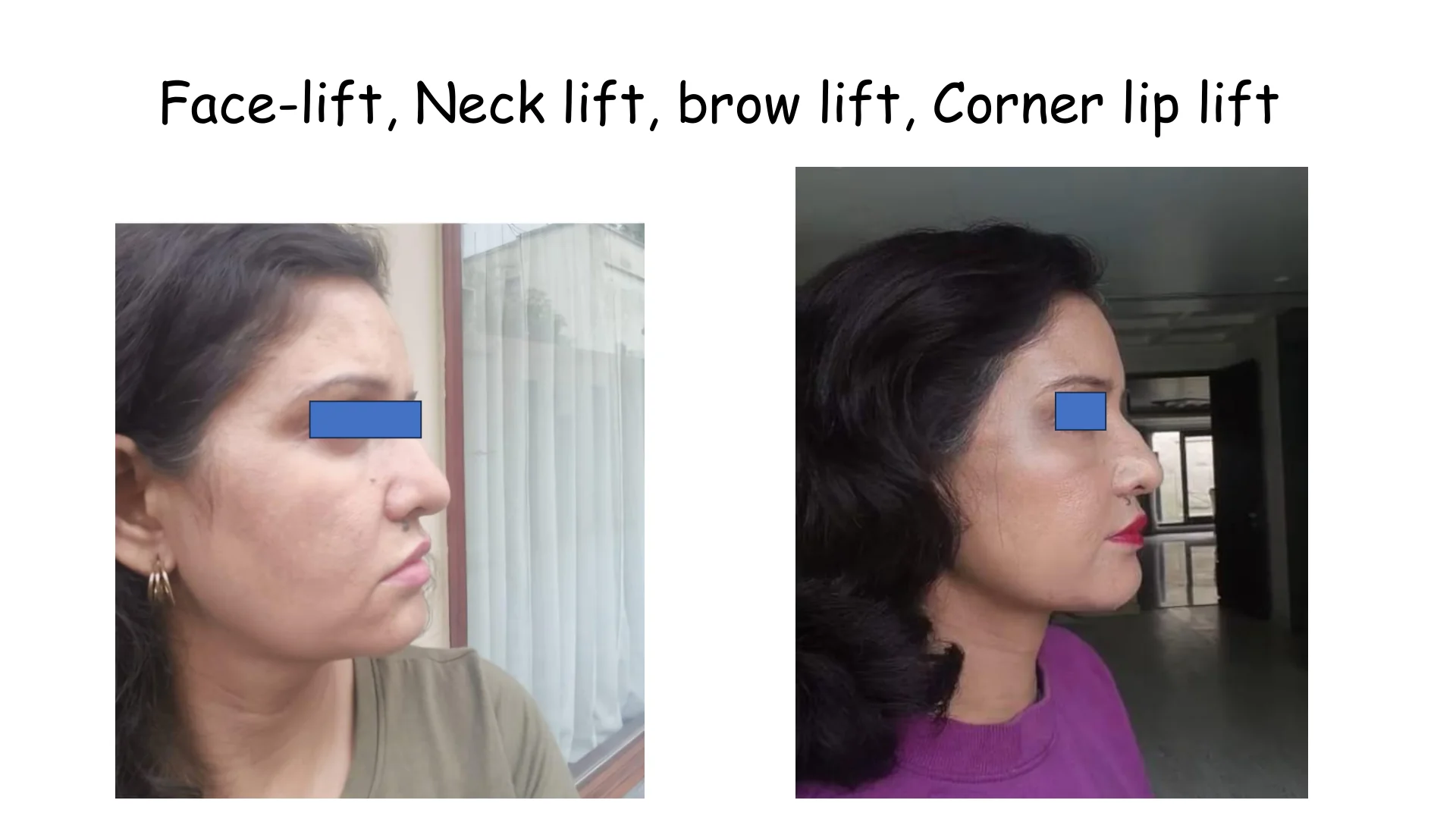 Lip Lift Transformation 5