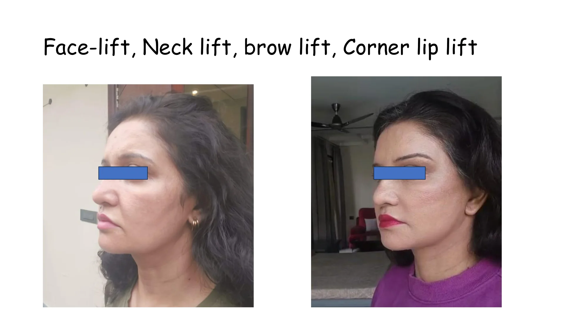 Lip Lift Transformation 6