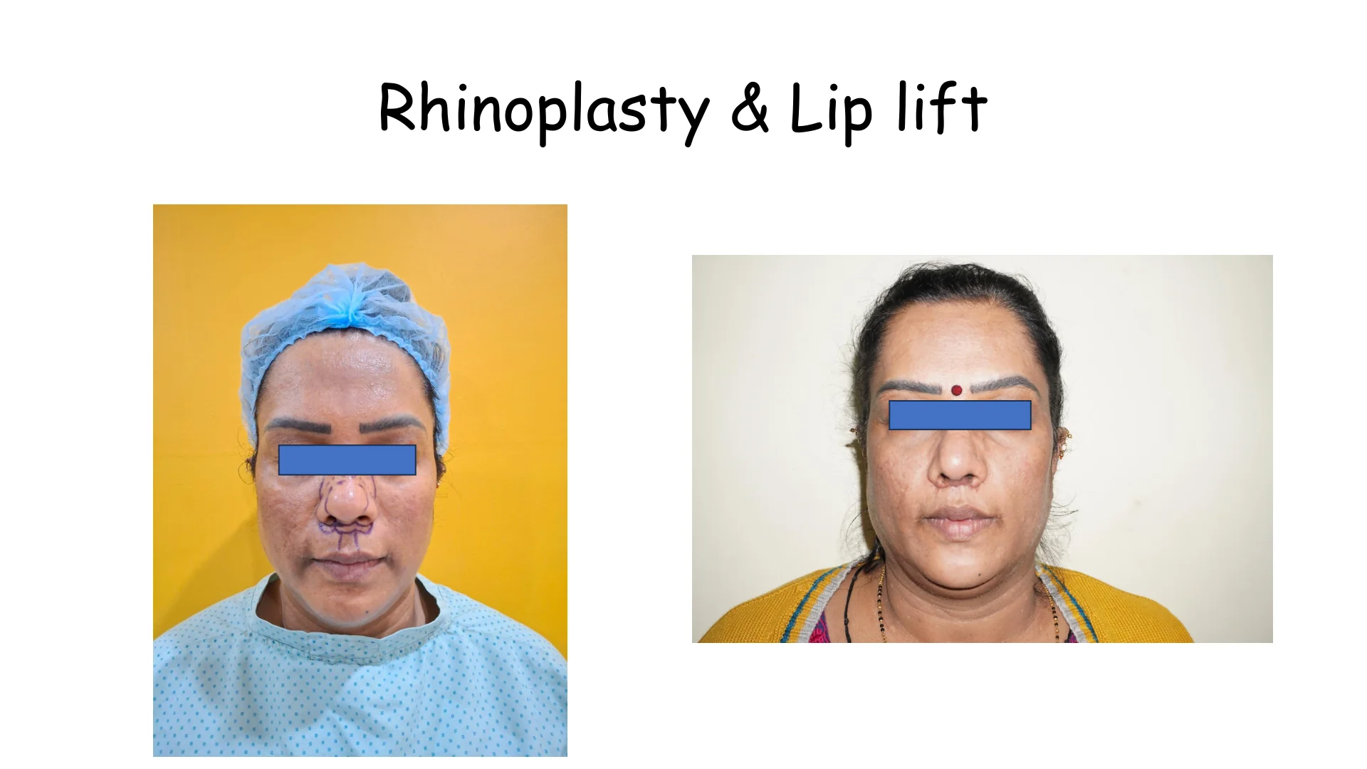 Lip Lift Transformation 7