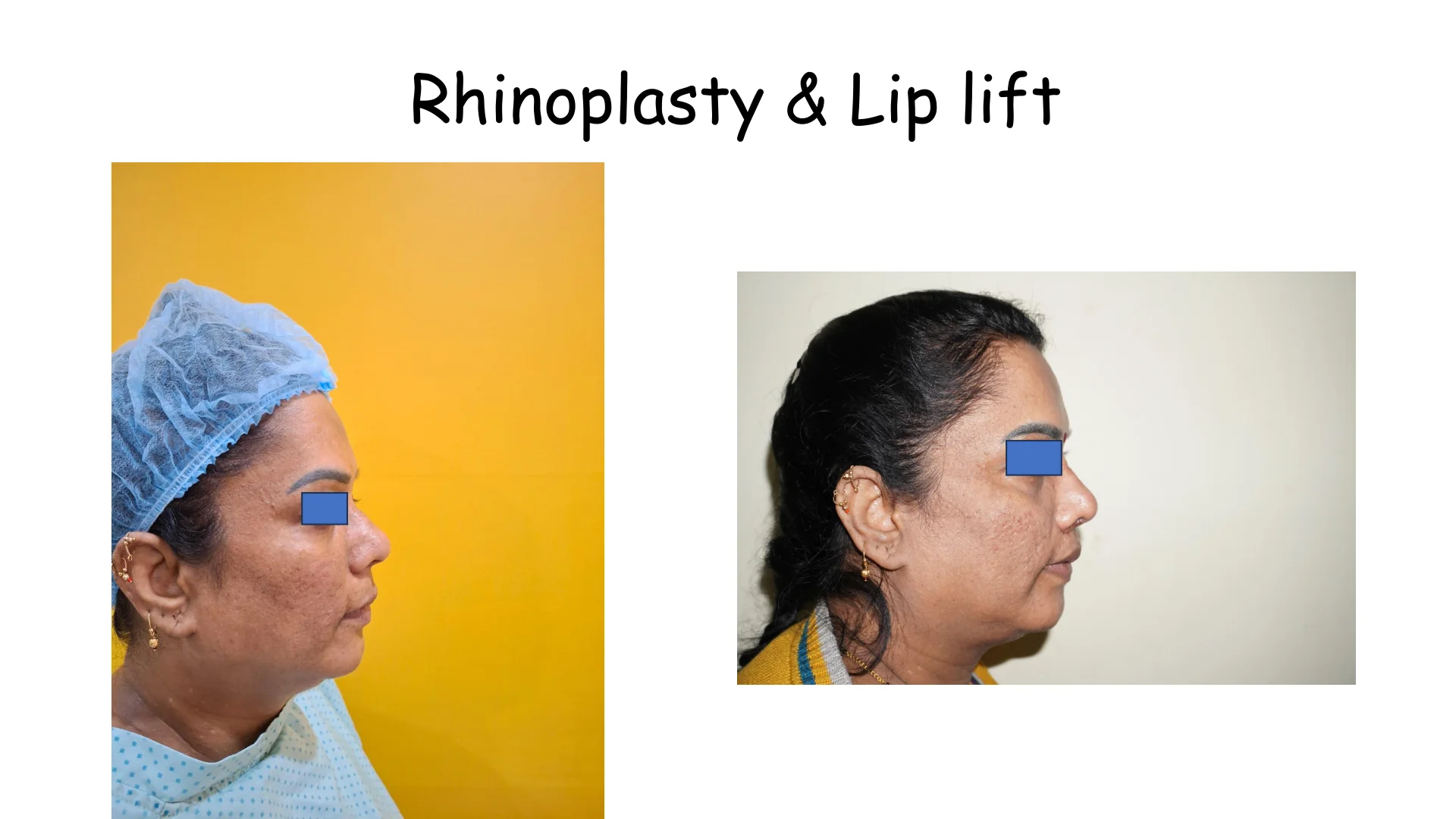 Lip Lift Transformation 8