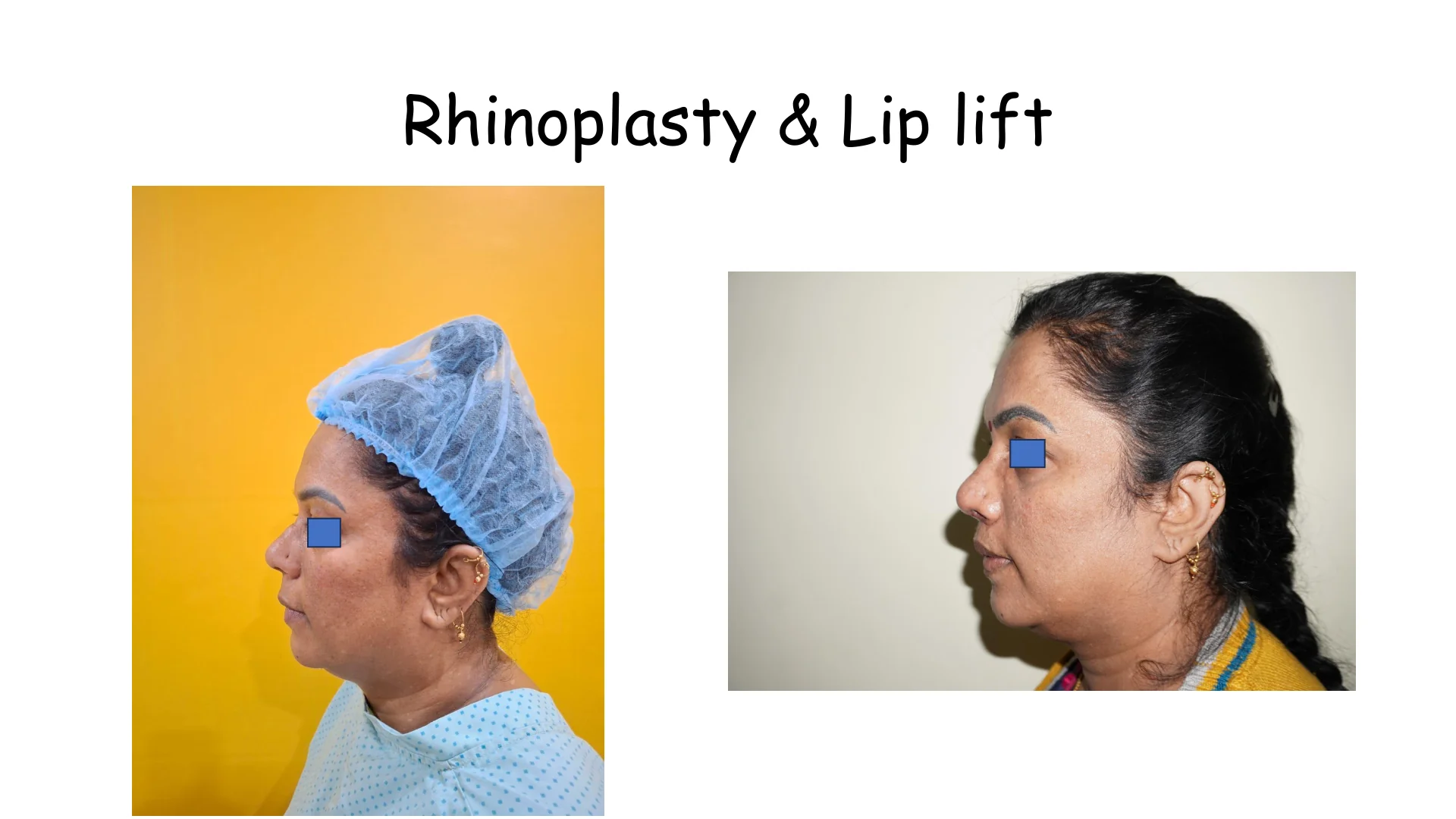 Lip Lift Transformation 9