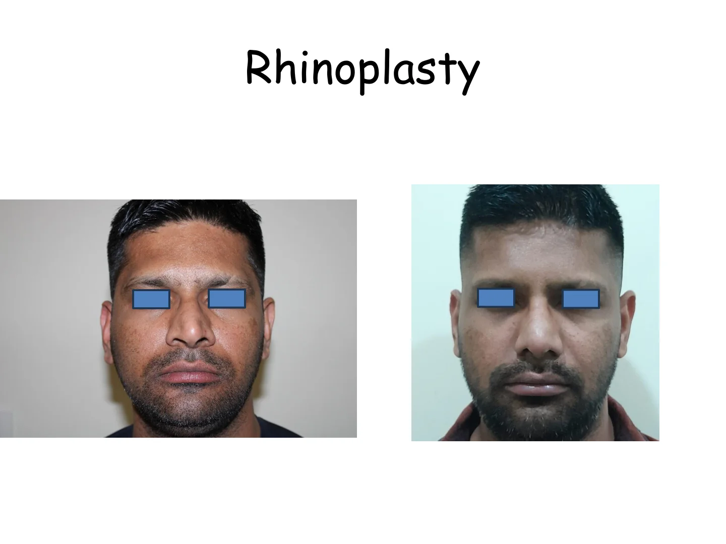Rhinoplasty Transformation 1