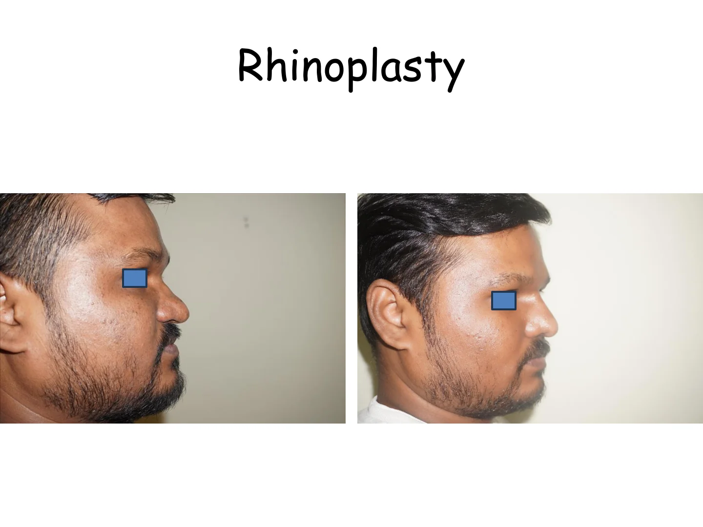 Rhinoplasty Transformation 10