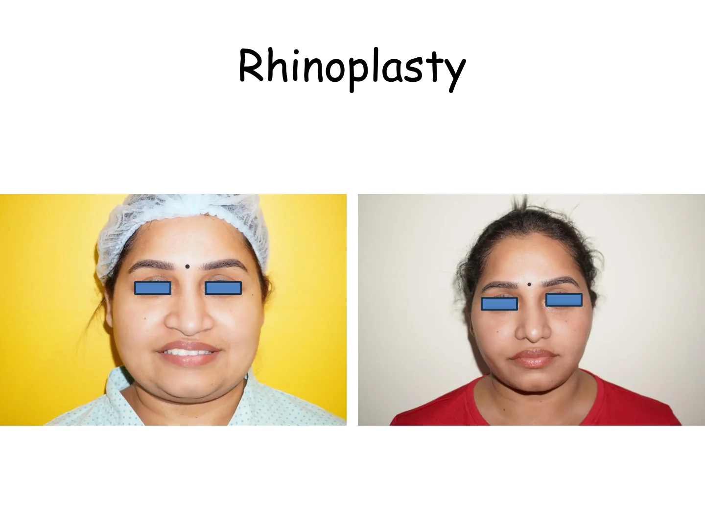 Rhinoplasty Transformation 11