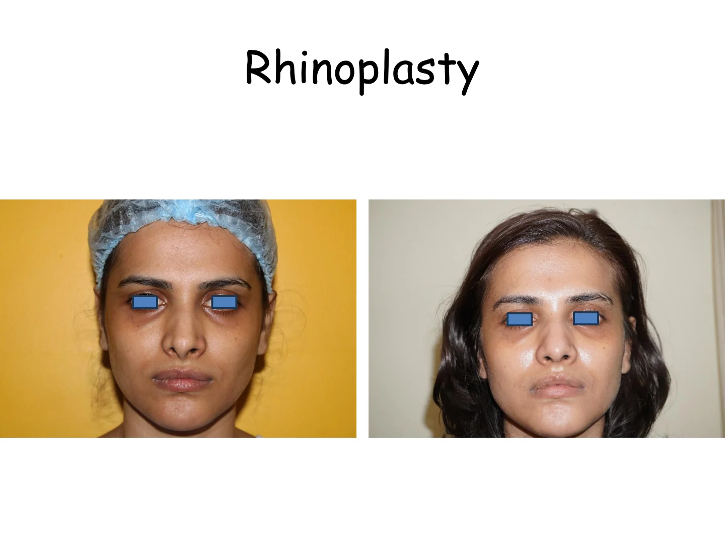 Rhinoplasty Transformation 12