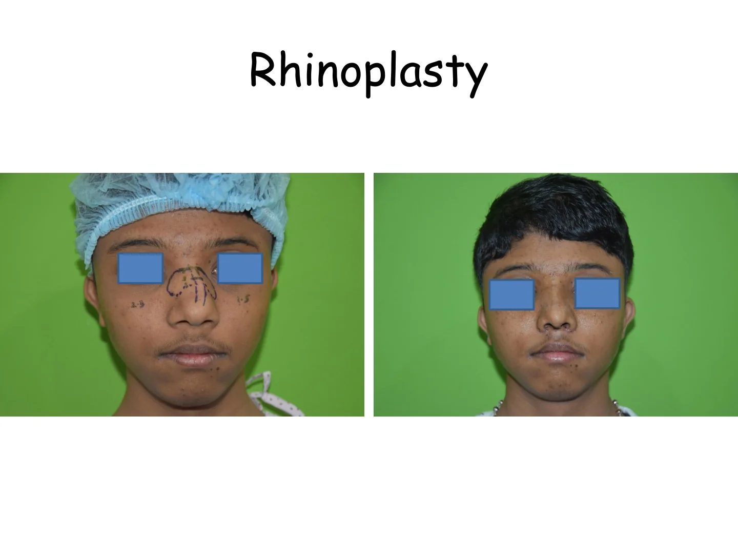Rhinoplasty Transformation 13
