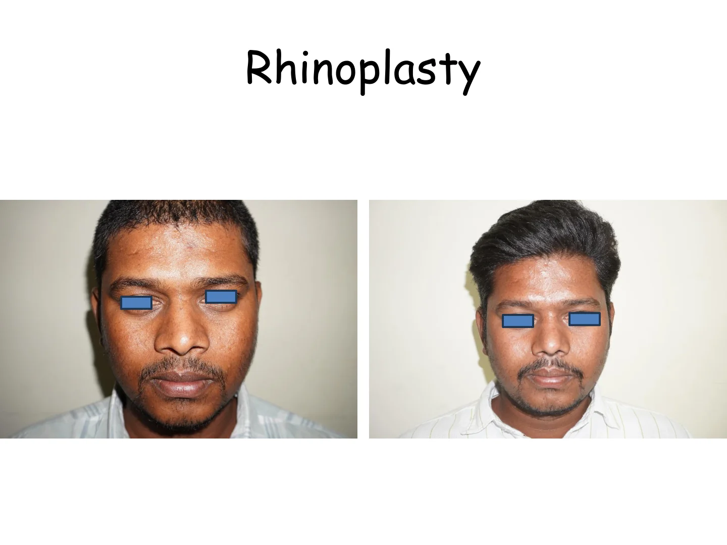 Rhinoplasty Transformation 14