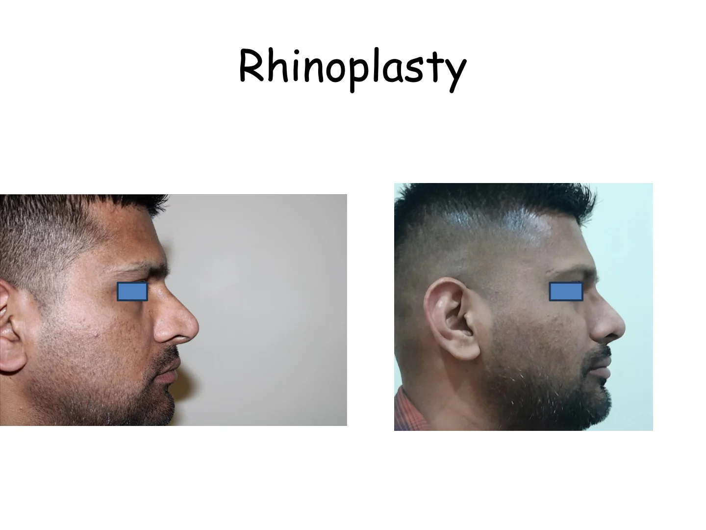 Rhinoplasty Transformation 2