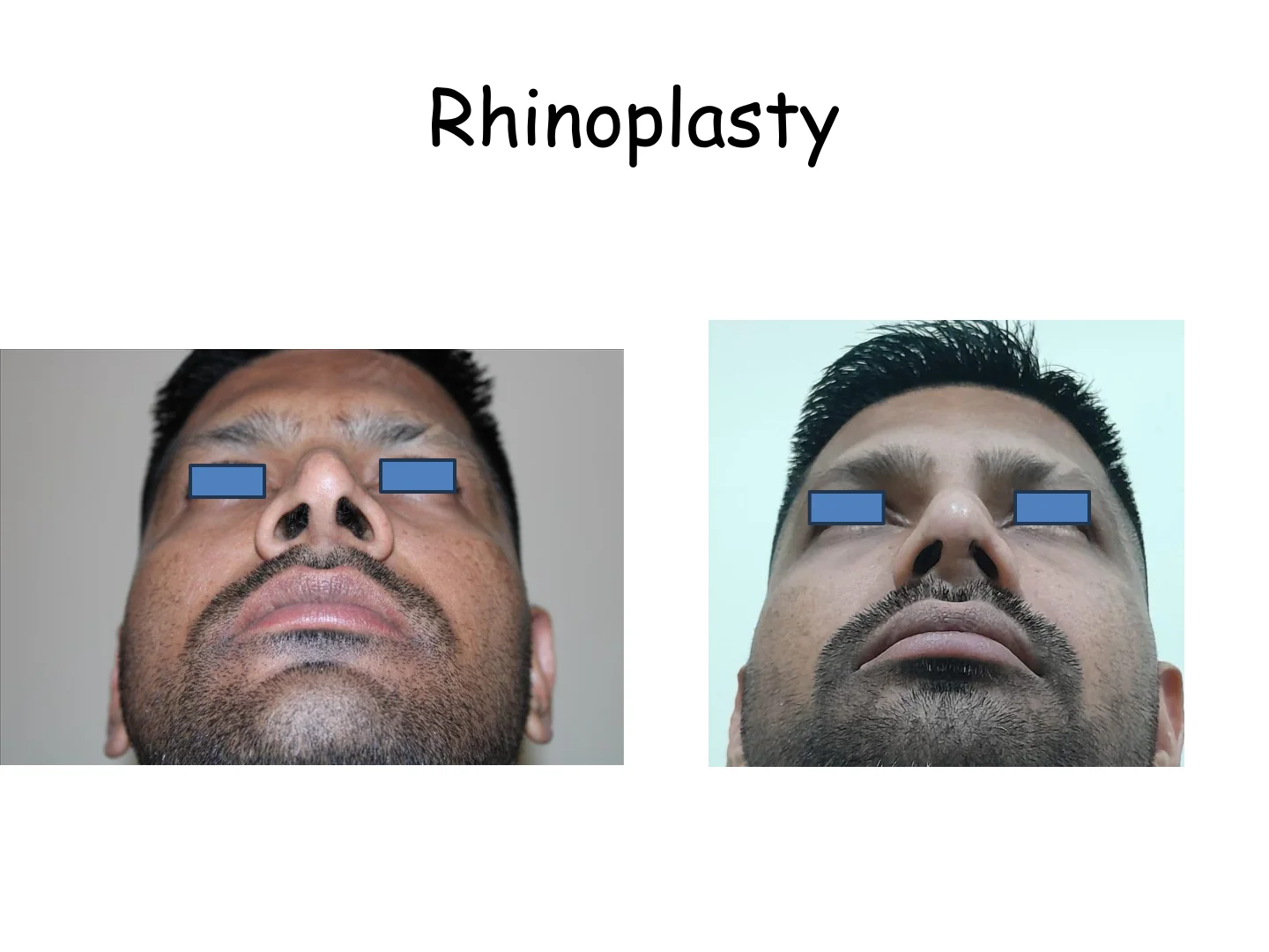 Rhinoplasty Transformation 3