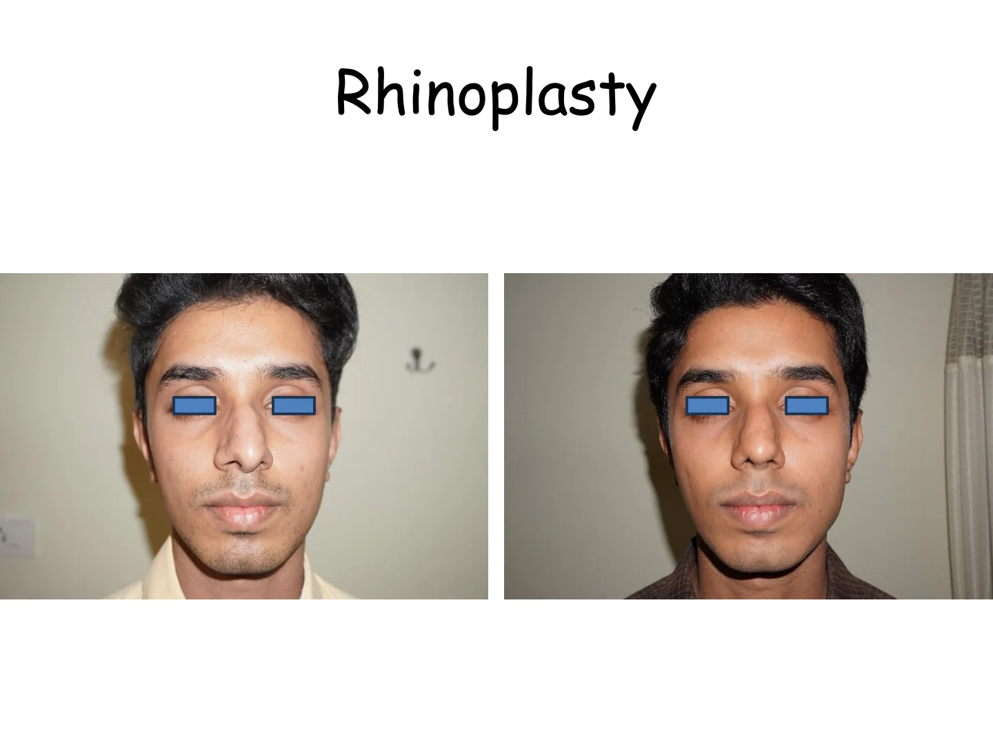 Rhinoplasty Transformation 4