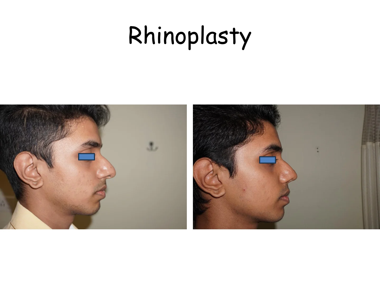 Rhinoplasty Transformation 5