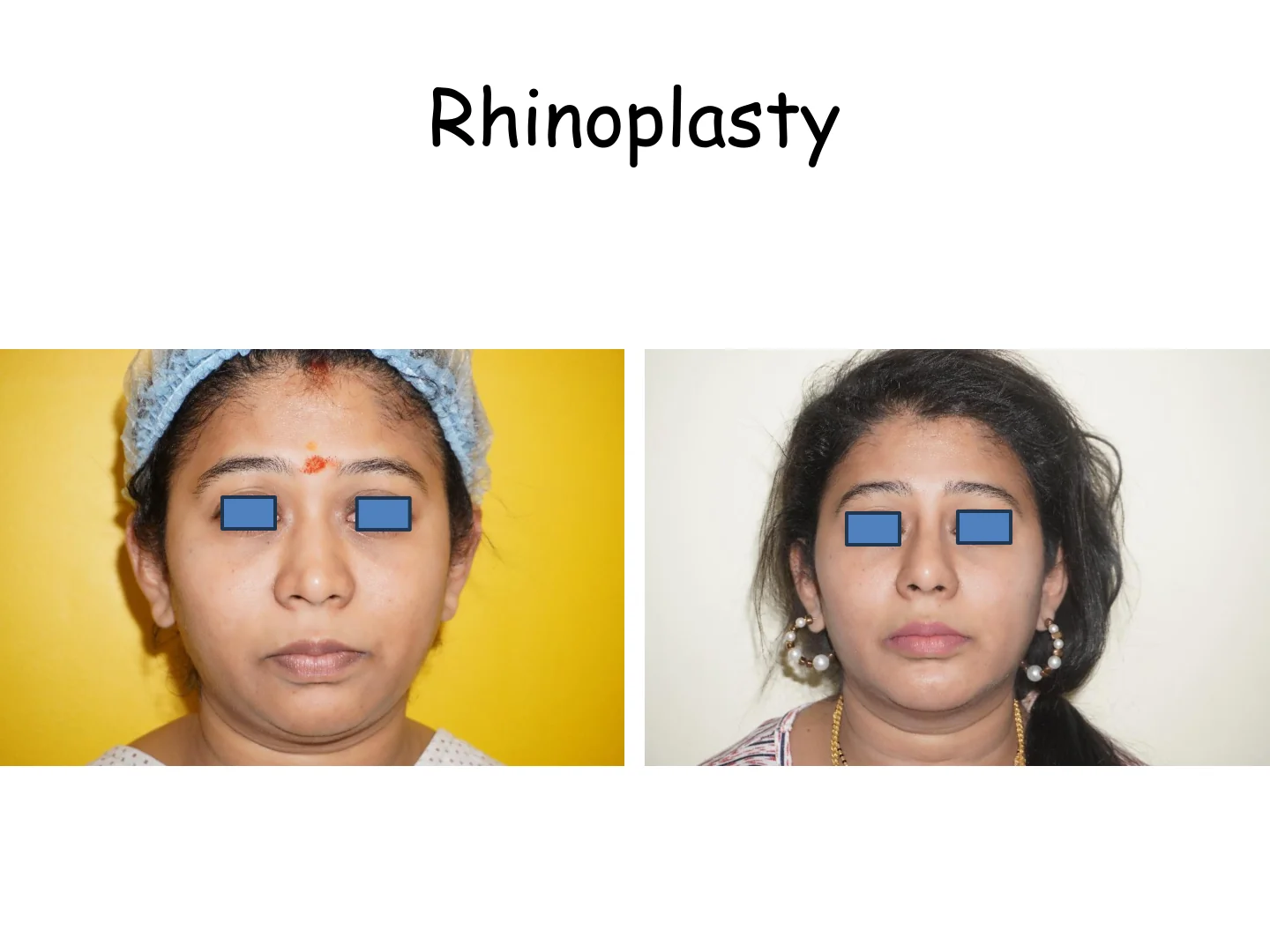 Rhinoplasty Transformation 6