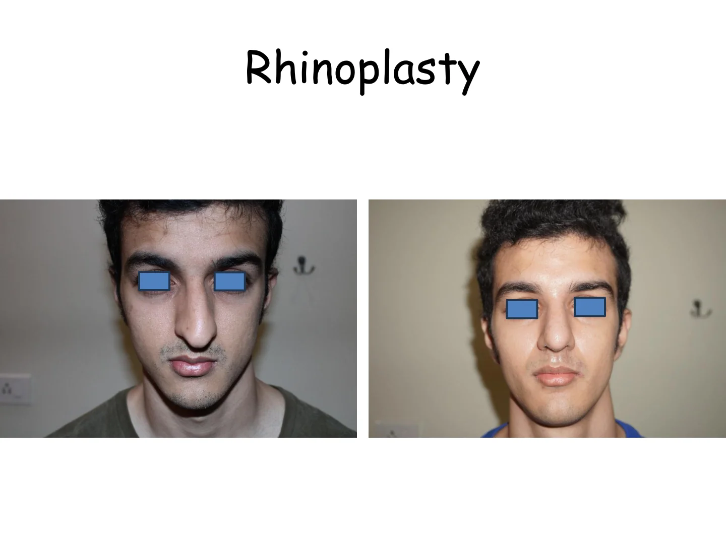 Rhinoplasty Transformation 7