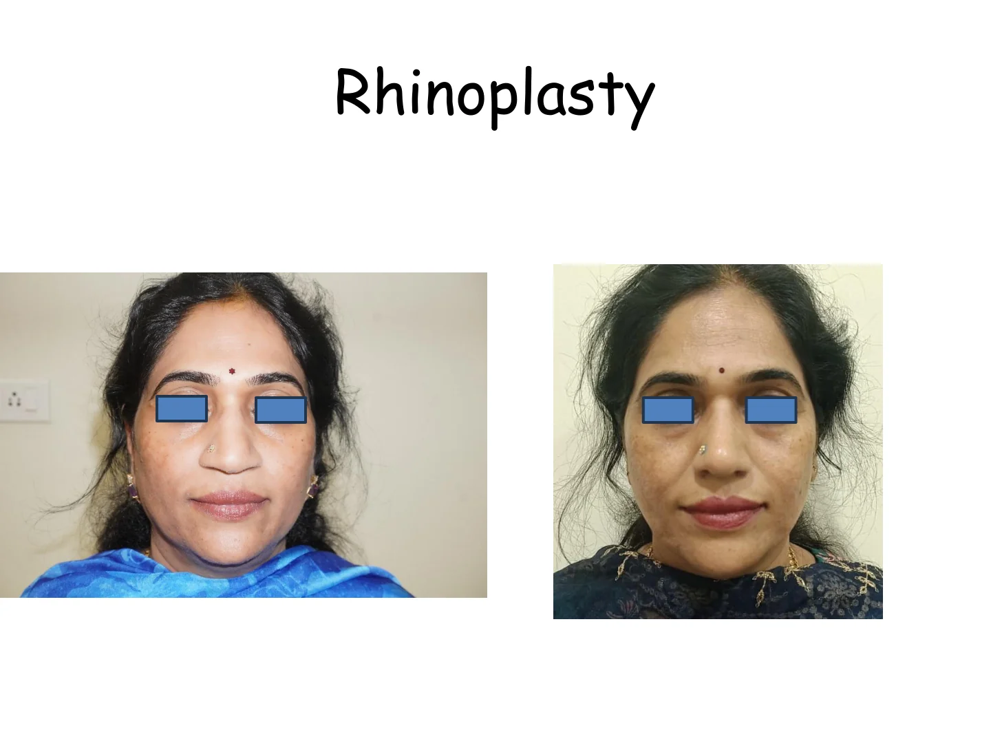 Rhinoplasty Transformation 8
