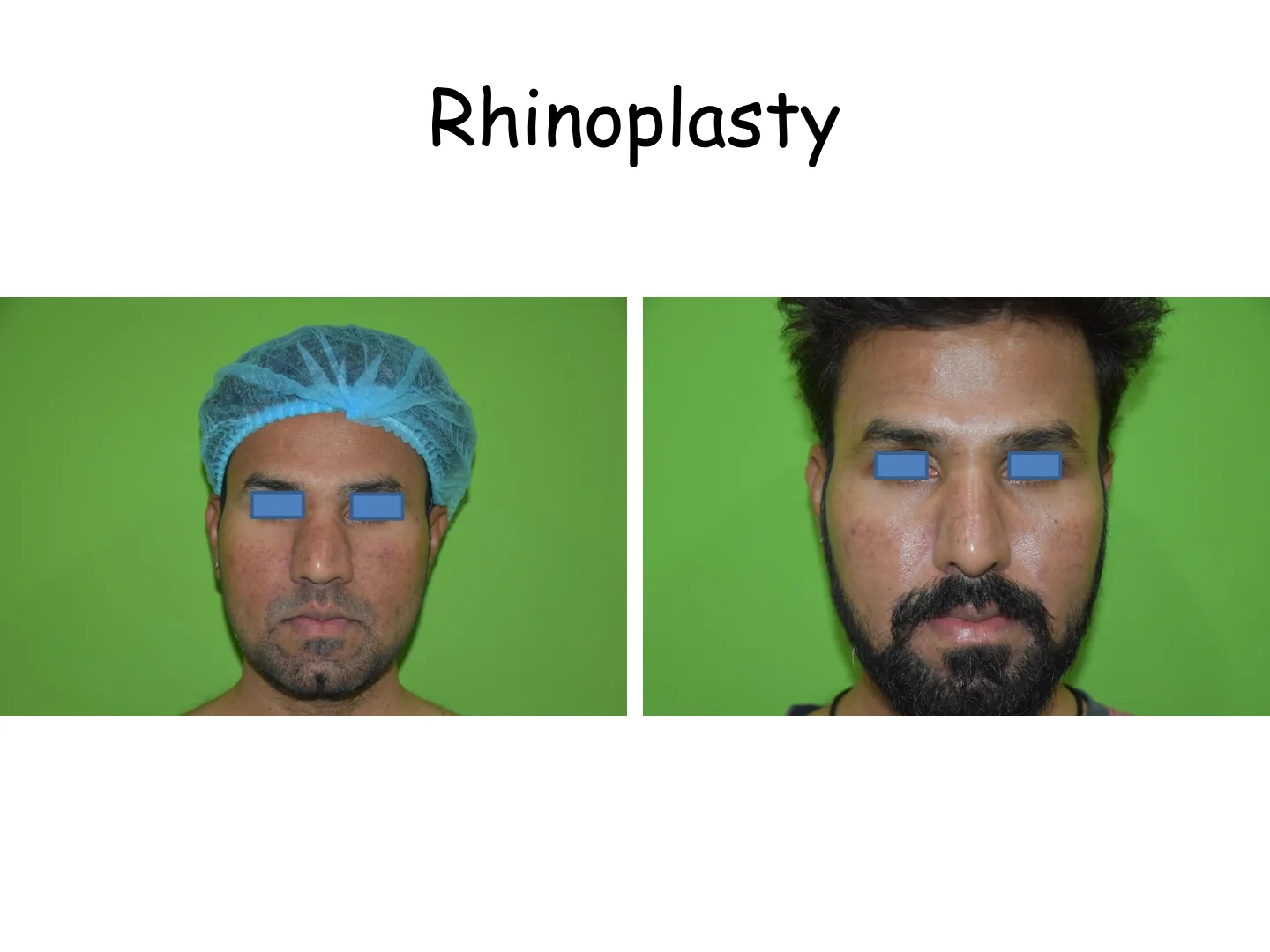 Rhinoplasty Transformation 9