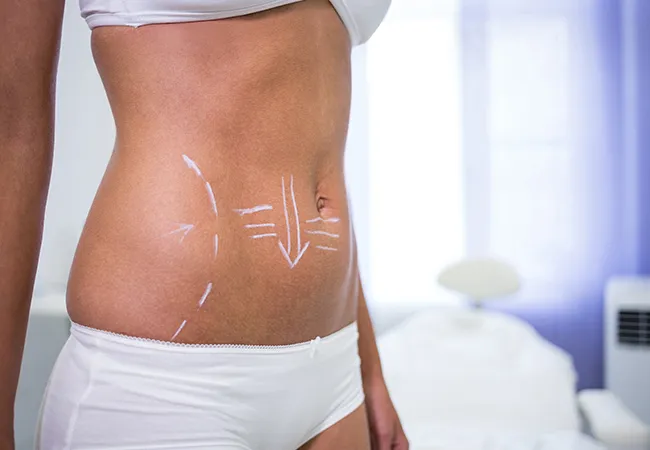 3D Liposuction Surgery