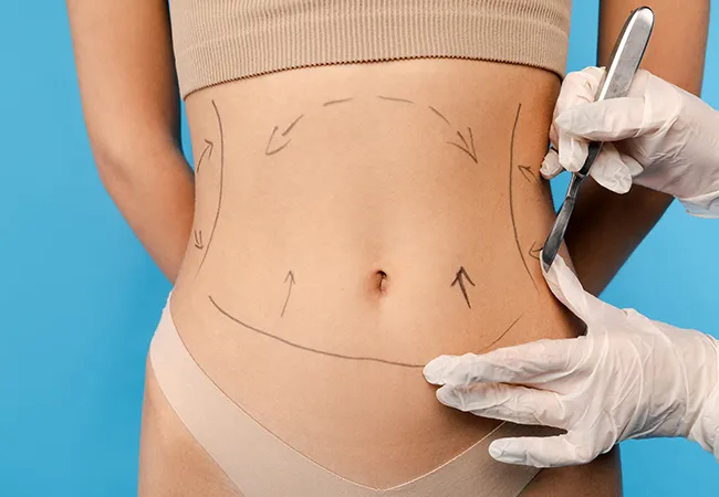 Abdominal Liposuction Surgery