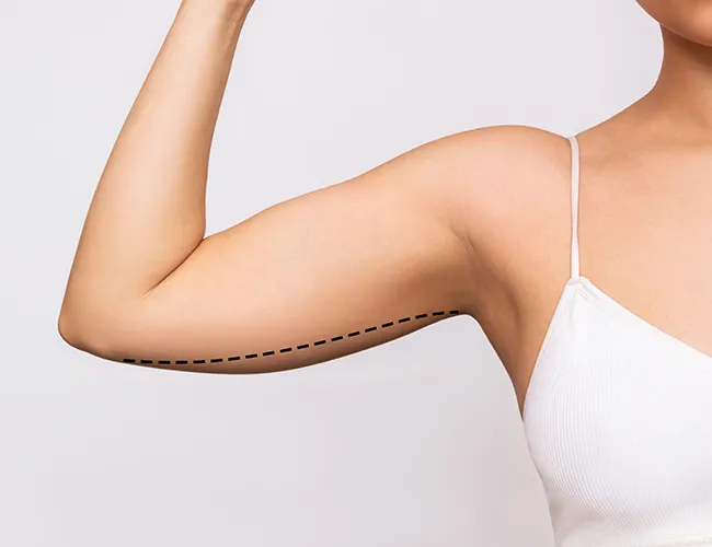 Arm Lift Surgery Cost