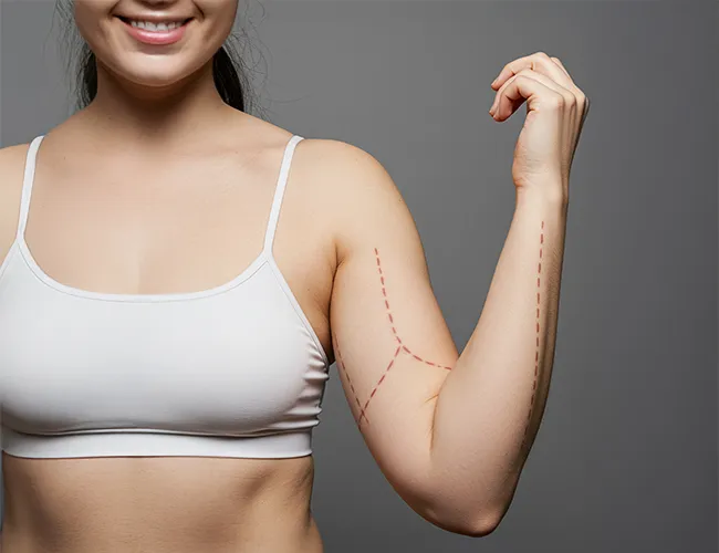 Arm Lift Surgery Before and After