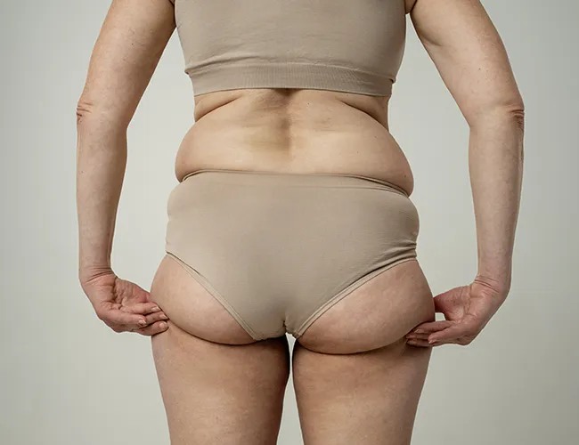 Buttock Lift Surgery Cost