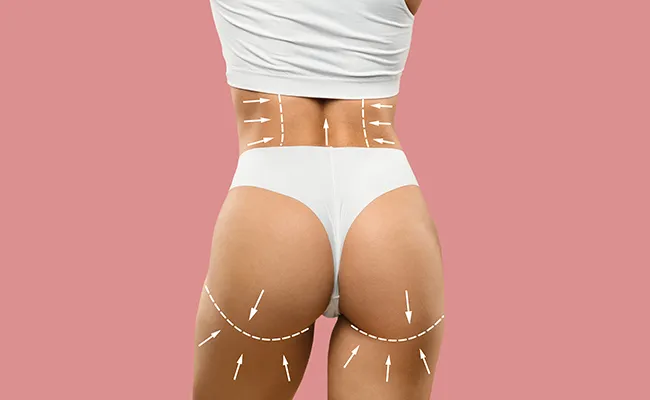 Buttock Lift Surgery