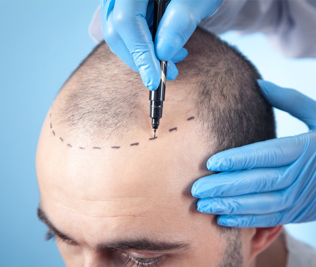 FUE Hair Transplant Benefits