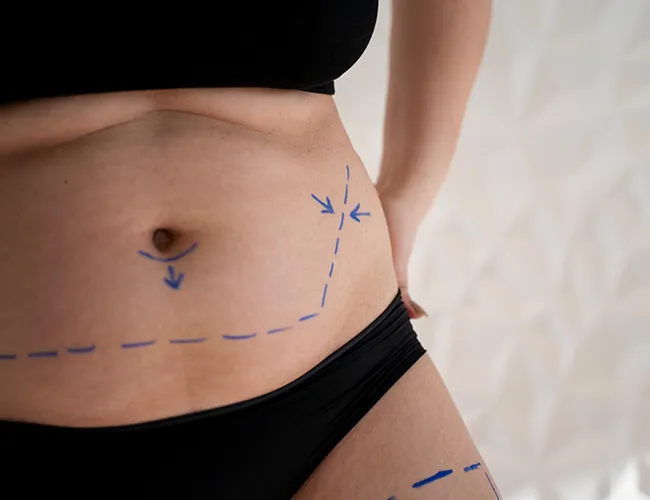 Fat Grafting Surgery