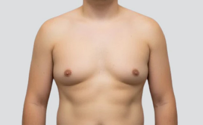 Gynecomastia Surgery