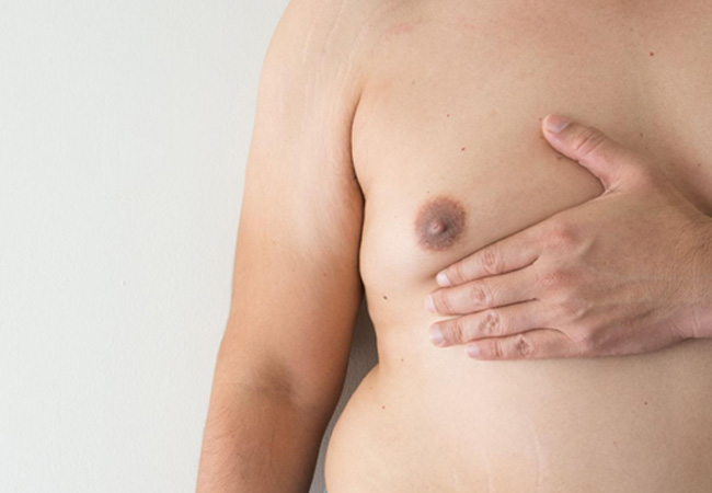 Gynecomastia Surgery Cost