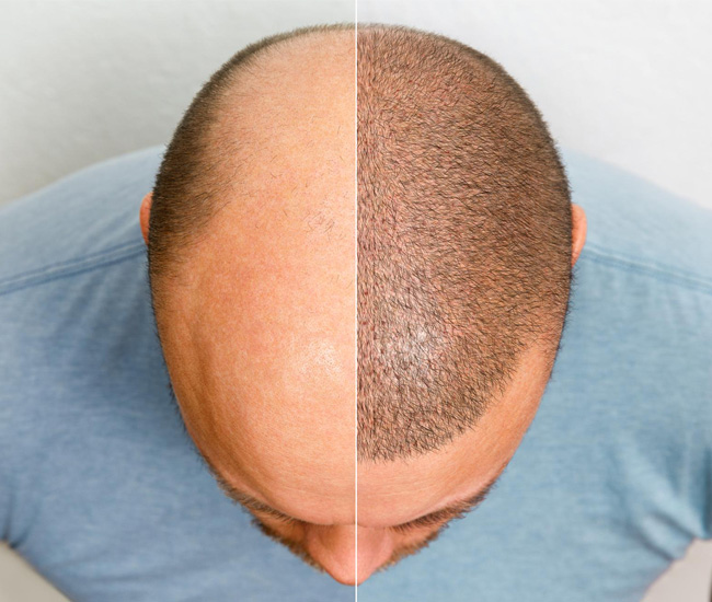 Why Choose Curls & Curves for Hair Regrowth Solutions in Bangalore?