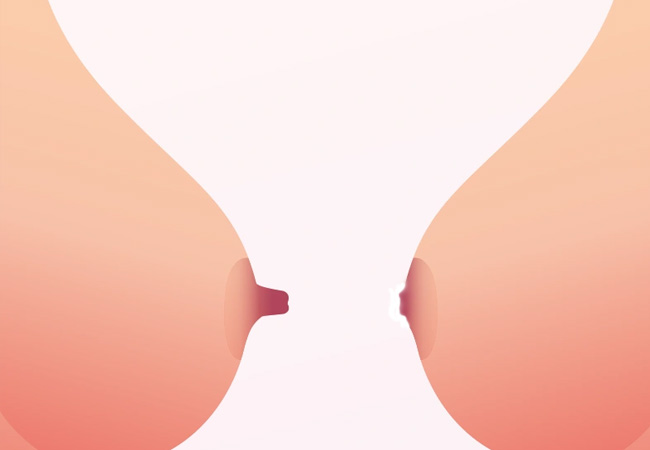 Inverted Nipple Surgery