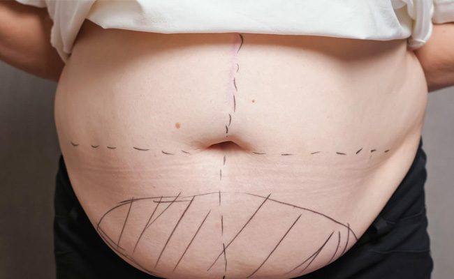 Mommy Makeover Surgery