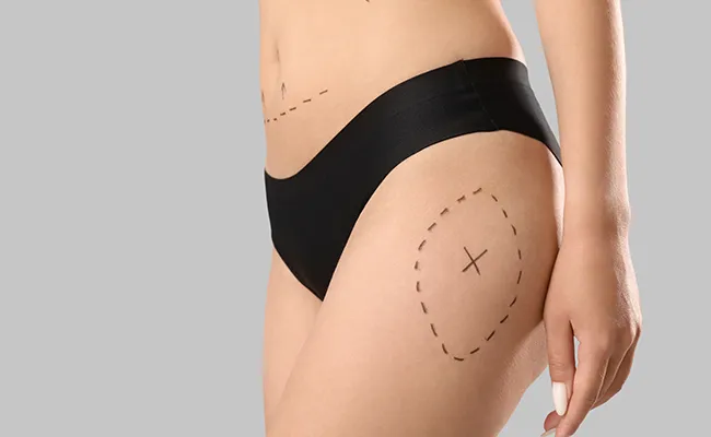 Thigh Liposuction Cost